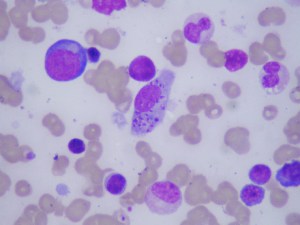 Bone marrow aspirate of a Bangladeshi with fever.