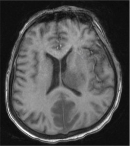 MRI of the brain (T1)