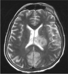 MRI of the brain (T2)