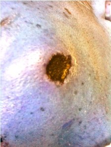 Necrotic skin lesion with minimal surrounding inflammation.