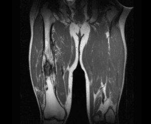 MRI of the femur showing (on the right femur) the changes of chronic osteomyelitis.