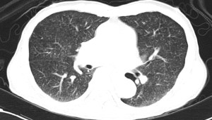 CT thorax - lung window