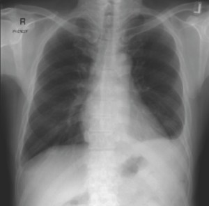 Chest X-ray of the man with a nodule over his back.