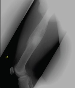 X-ray of the right femur.