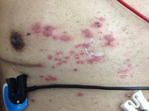 Rash in an elderly gentleman with cancer.