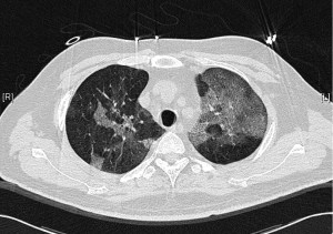 CT Thorax: patient post allo-HSCT with a cough.