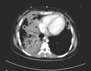 CT thorax showing predominantly right-sided consolidation and cavitation of the lungs.