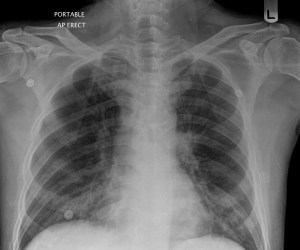 Chest X-ray - patient post allo-HSCT with a cough.