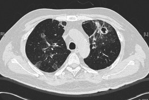 Same CT showing cavities in the left lung.