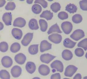 Blood film of the man on a missionary trip to Gambia