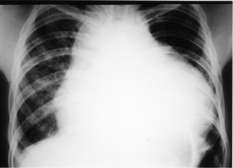 Chest X-ray of the sailor who was ill for 2 months.