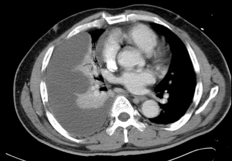 CT thorax - massive right pleural effusion.