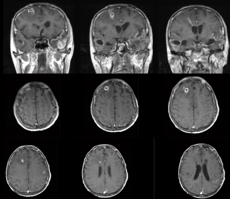 CT head showing inflammation along the tract of the former EVD.