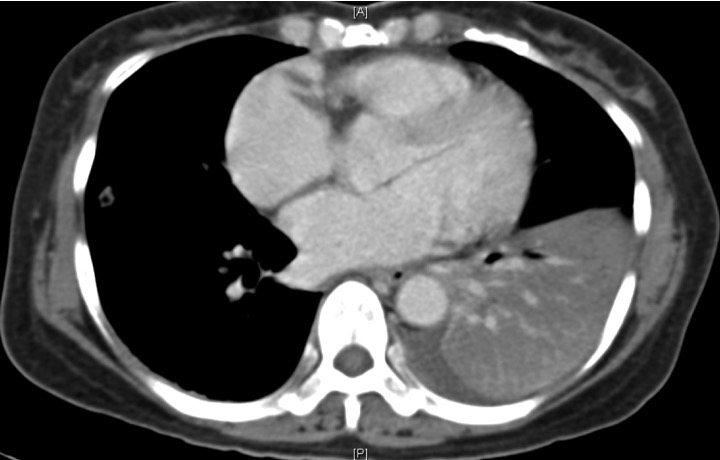 CT image of neutropenic woman with ALL, showing dense consolidation of the left lower lobe.