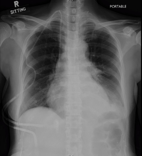 Figure 1. Chest X-ray of neutropenic patient with ALL, showing left lower zone infiltrates.