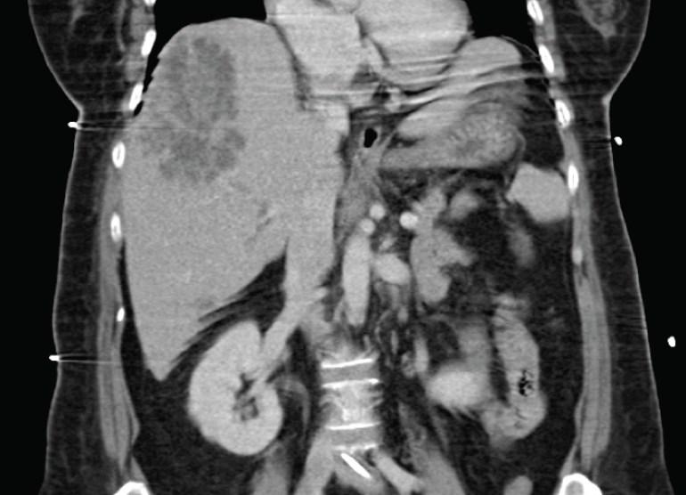 CT abdomen showing a large irregular lesion in the liver.