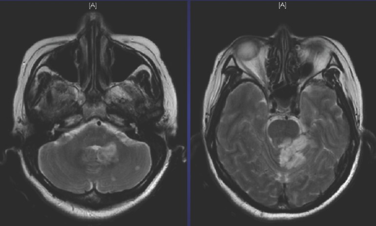 MRI brain showing brainstem and cerebellar infarcts.