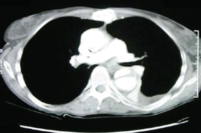 CT thorax image showing the aortic dissection, with a larger false lumen.