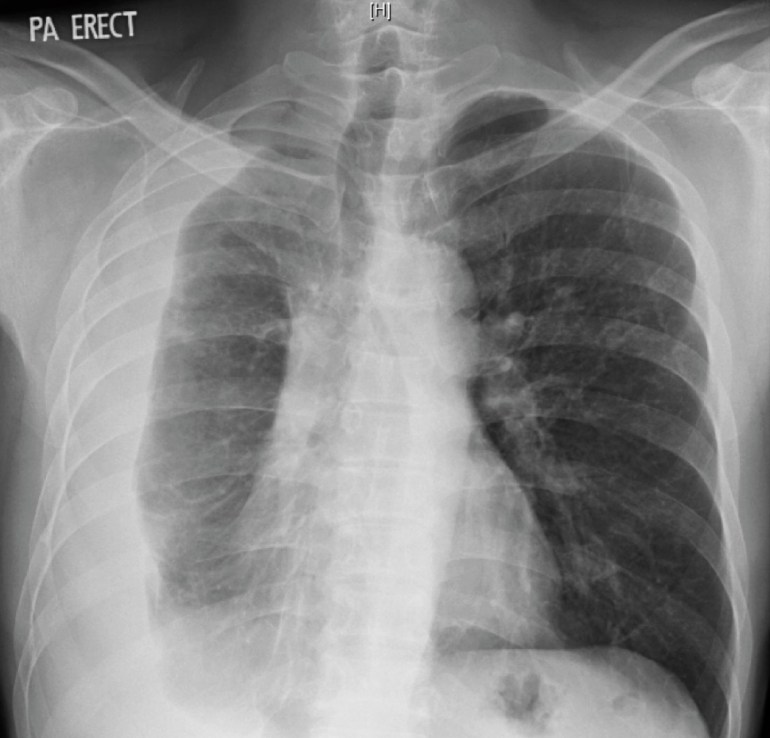Initial chest X-ray of the man with renal transplant, showing a right-sided loculated pleural effusion.