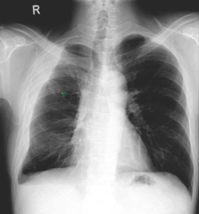 Chest X-ray of the patient with TB pleural effusion and paradoxical response to therapy one year after starting TB treatment.