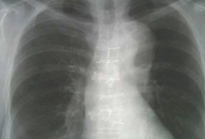 Chest X-ray of the elderly gentleman with chest pain.