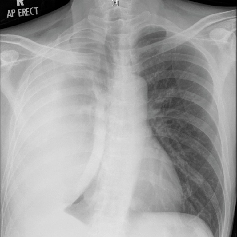 Chest X-ray 2 months after starting anti-tuberculosis therapy, showing a massive right pleural effusion.