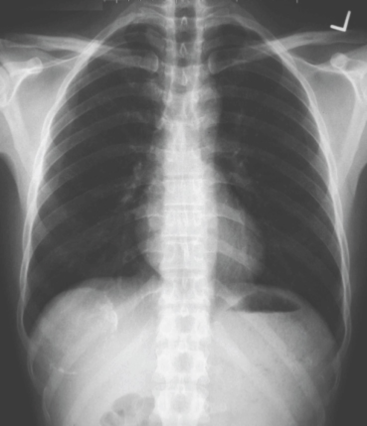 Chest X-ray of the man with right-sided abdominal pain.