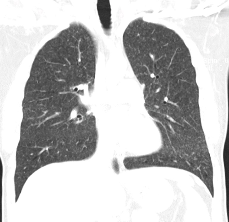 CT thorax (lung window) showing very small nodular shadows in both lung fields (coronal cut).