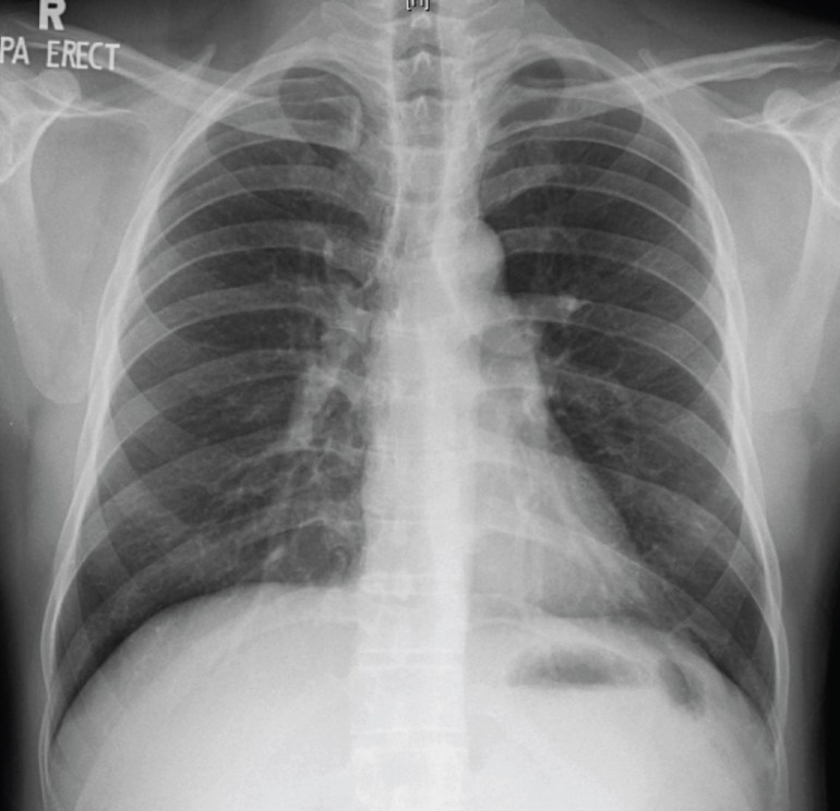 Chest X-ray of the middle-aged man with fever and cough for 2 weeks. 