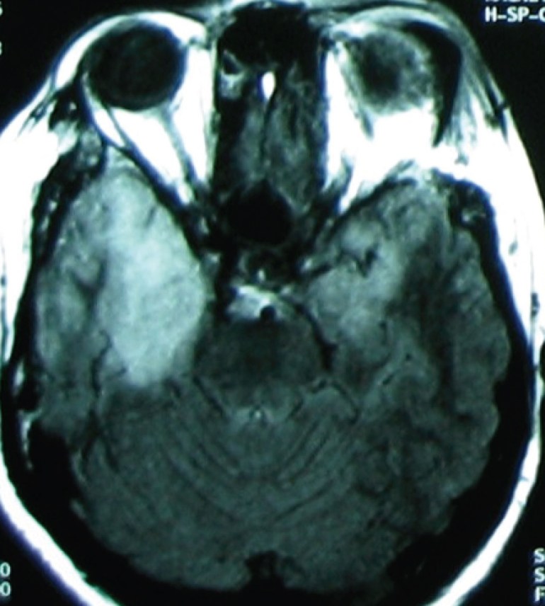 MRI (T2 image) of the woman with fever and impaired consciousness.