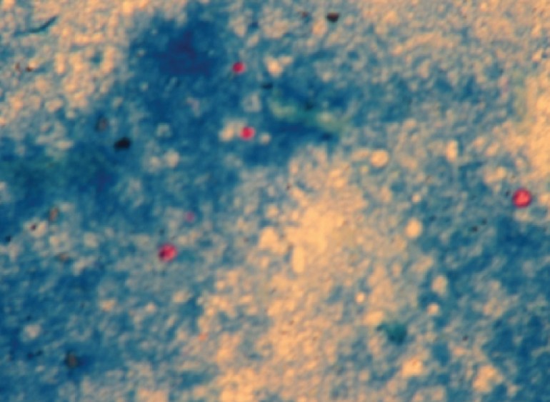 Modified acid fast staining of stool showing 4 cysts approximately 9-10 micrometers (inferior 2 cysts) and 4-5 micrometers (upper 2 cysts) in size.