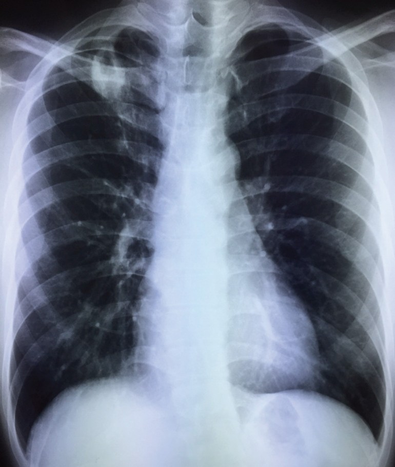 Chest X-ray of a young man, asymptomatic.
