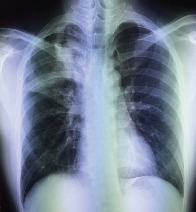 Chest X-ray of the young man, one week later.