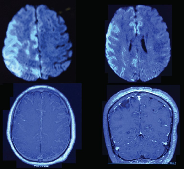 MRI images of the man with fever and left hemiparesis.