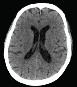 CT head of the woman with fever and headache. Normal scan.