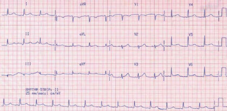 ECG of a middle-aged man with chest pain.