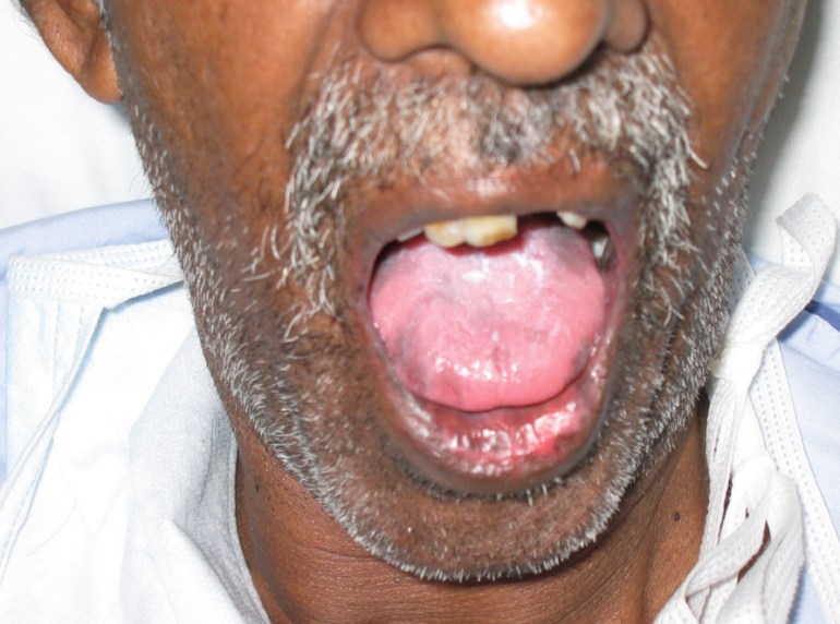 Tongue of the hypotensive patient.