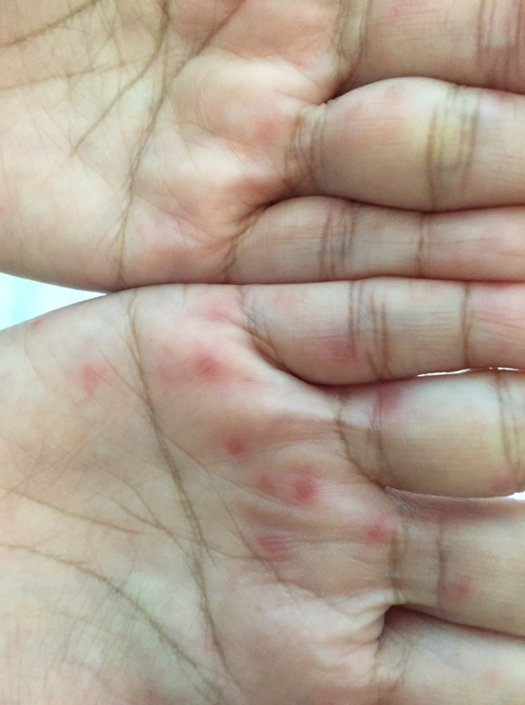 Lesions on the hands of a young pregnant woman.