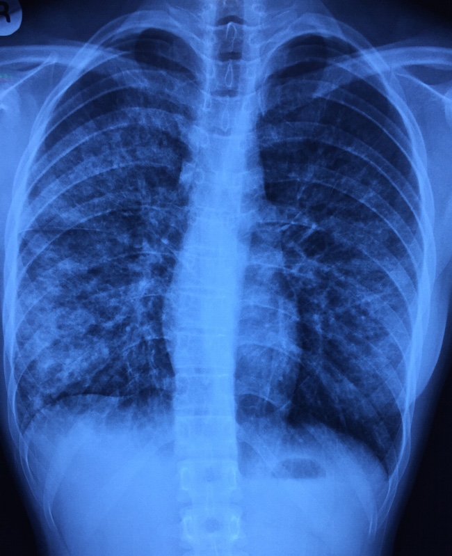 Chest X-ray of the teenager with acute onset of fever and cough.
