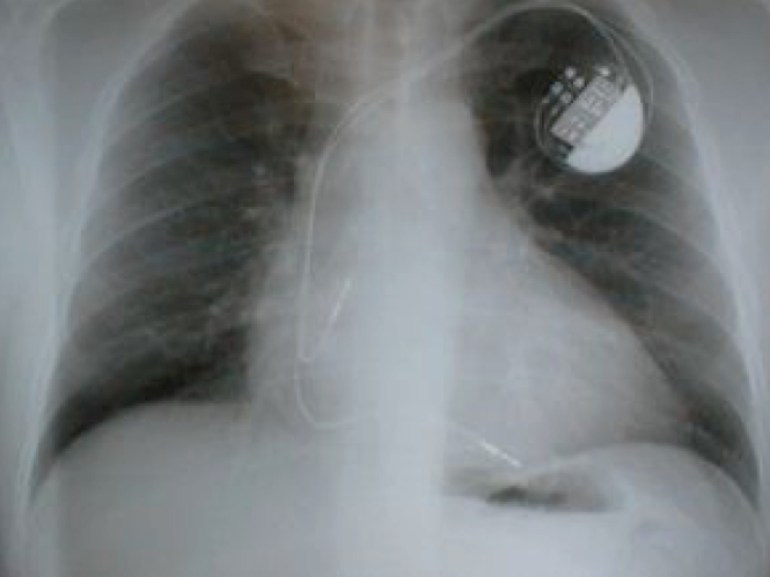 Chest X-ray of the man showing a biventricular pacemaker.